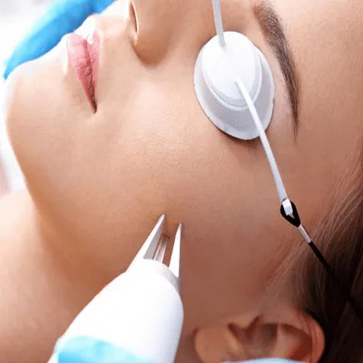 CO₂ laser treatment