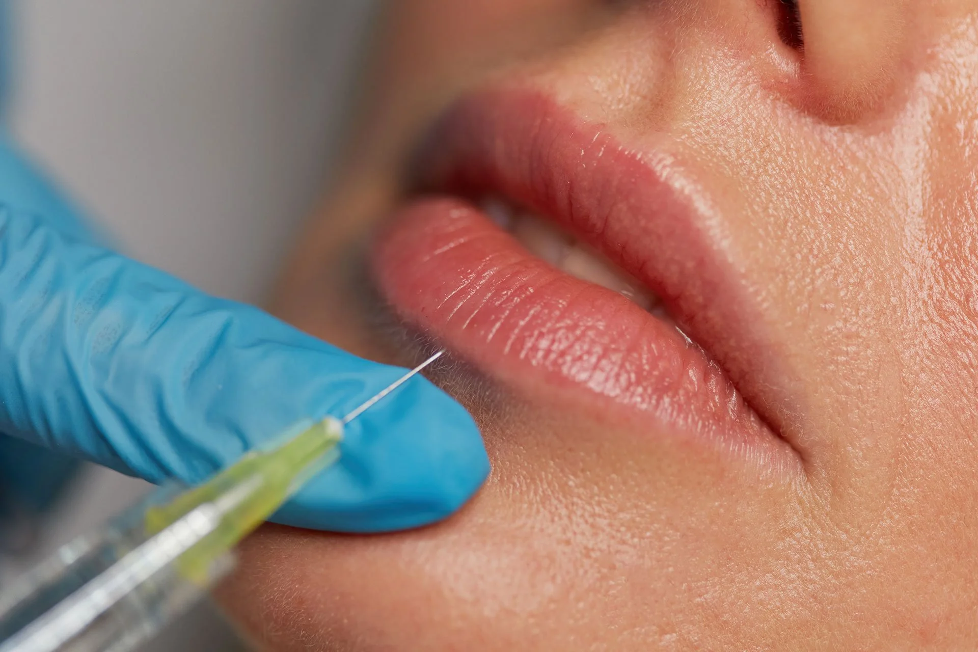 Dermal Fillers